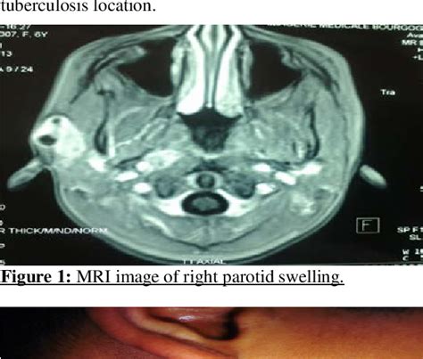 Figure 1 From Tuberculosis Of The Parotid Gland In Children A Report Of