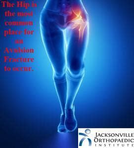 Avulsion Fractures JOI Jacksonville Orthopaedic Institute