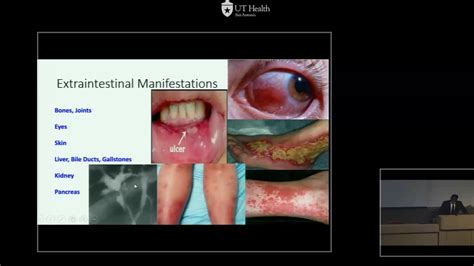 Gr 02 13 17 Inflammatory Bowel Disease Dr Andrew Adams Youtube