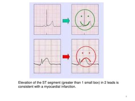 Ppt Electrocardiogram Ecg Iii Powerpoint Presentation Free Download