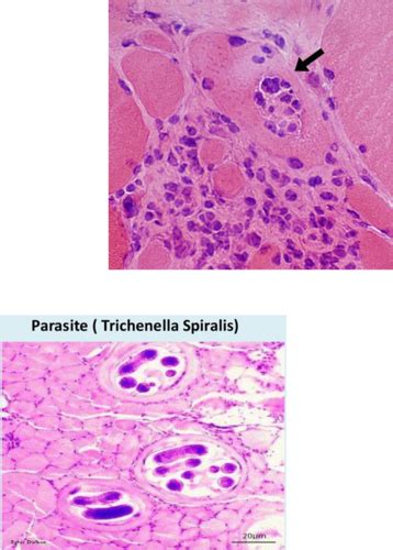 MSK 2 Patho 3 Inflammatory Muscle Disorders Flashcards Quizlet