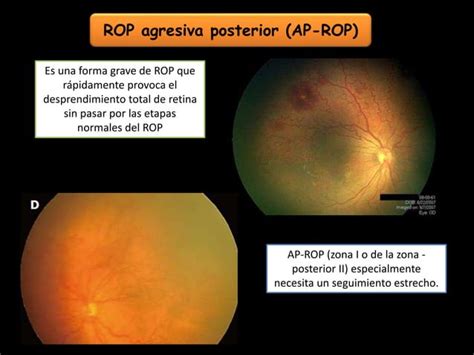 Retinopatia Del Prematuro PPT