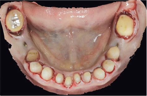 The Mandibular Arch Showing The Right Central Incisor And The Second