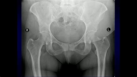 Radiology Pelvis And Hip Trauma Youtube