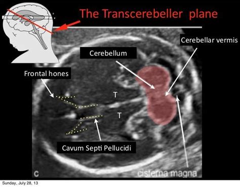 Cerebellar Vermis Fetal Ultrasound