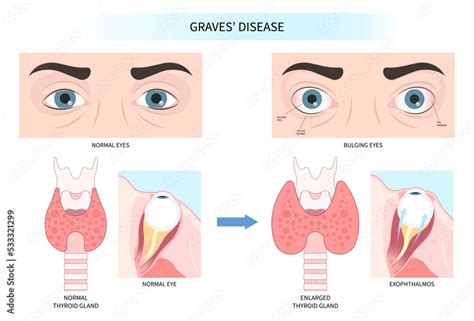 Hashimotos Thyroiditis And Graves Disease Eye Swollen Tumor Cancer Therapy Lump Enlargement