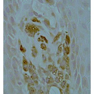 Low Power Histologic Aspect Of The Lesion A Demonstrating Exophytic