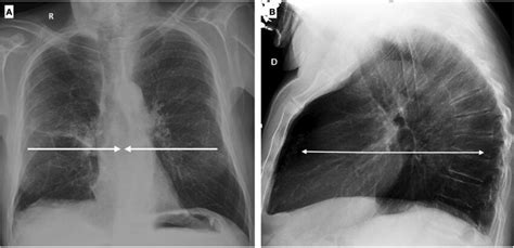 Chest X Ray In Postero Anterior A And Lateral Projection B Shows