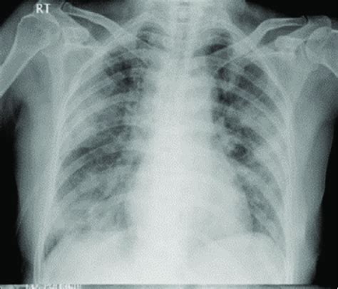 Case Number 1 Chest X Ray Postero Anterior View Before Treatment