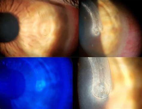 A Case Showing A Distal Apical Intracorneal Ring Segments Icrs