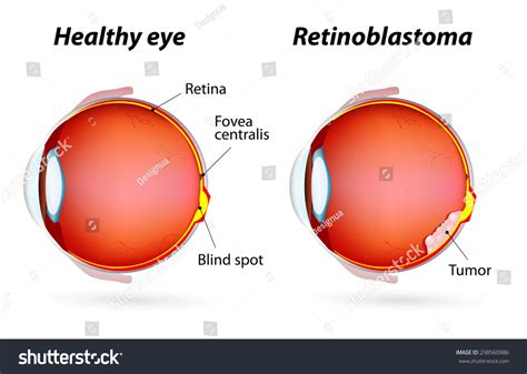 Retinoblastoma Tumor That Form On The Retina Eye Disease Lagerfoto