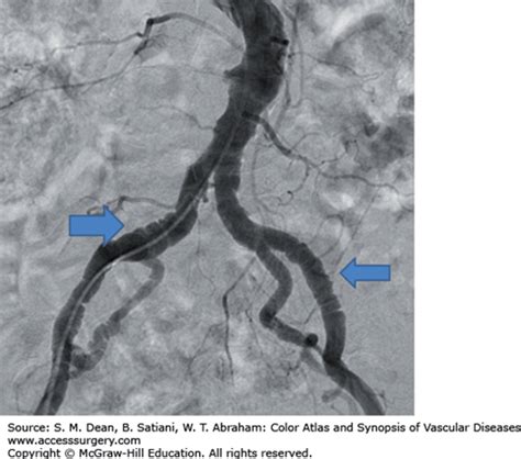 Carotid Artery Fibromuscular Dysplasia Thoracic Key