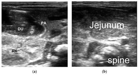 Duodenal Atresia Ultrasound