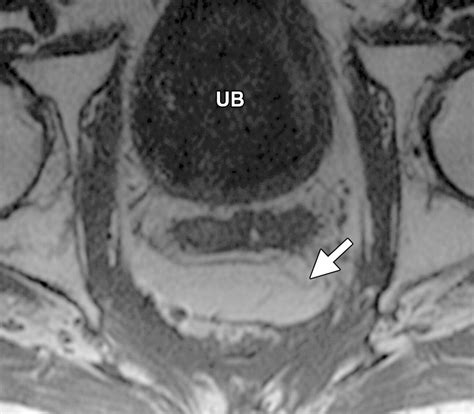 Pelvic Reconstruction With Omental And VRAM Flaps Anatomy Surgical