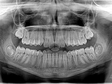 How Are Dental X-Rays Advantages?