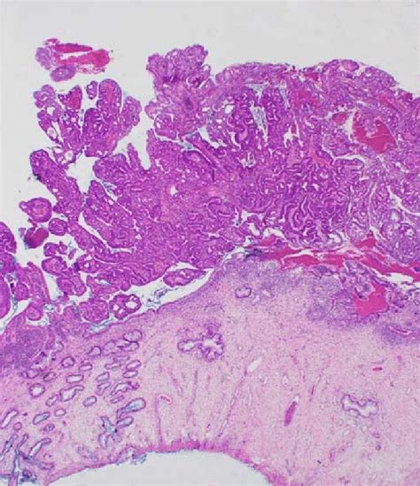 Exophytic Cervical Adenocarcinoma With Minimal Superficial Stromal