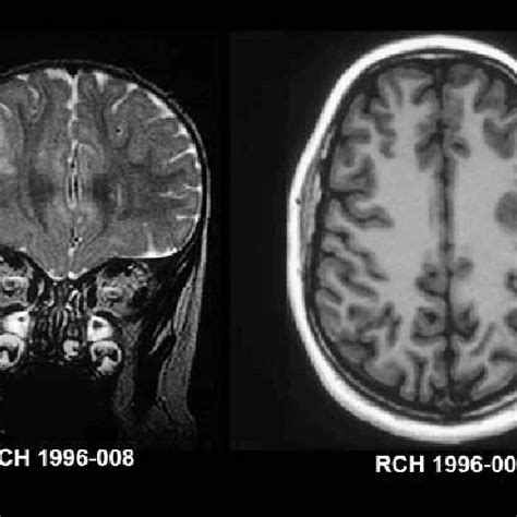 Imaging Features Of Periventricular Nodular Heterotopia Axial