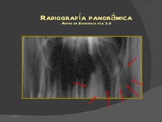 Reconstruccion Mandibular Con Injerto Libre Microvascularizado De