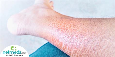 Skin Scales On Legs