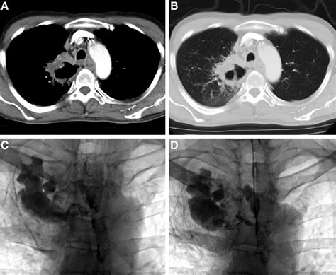 Fully Covered Self Expanding Metallic Stent Placement Or Thr Medicine