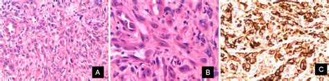 Histopathology A Cords And Small Nests Of Epithelioid Endothelial