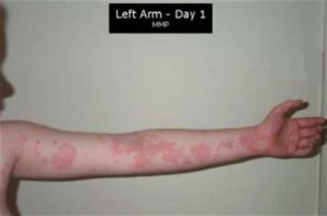 Causes of urticaria | General center | SteadyHealth.com