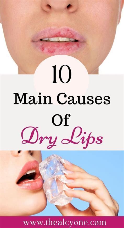 Reasons why you have dry cracked lips – Artofit