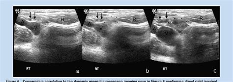 Direct Inguinal Hernia Ultrasound