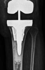 Use of an Antibiotic-Impregnated Spacer in Revision Total Knee ...