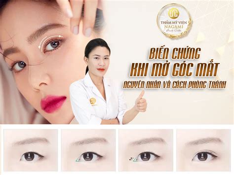 Biến chứng khi mở góc mắt Nguyên nhân và cách phòng tránh