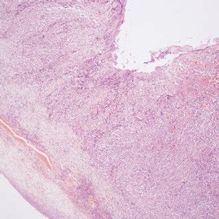 H E Stained Slide From The Perforation Site Pathological Examination