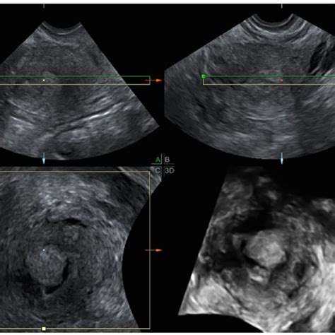 A 52 Year Old Woman With Endometrioid Adenocarcinoma Stage Ia Download Scientific Diagram