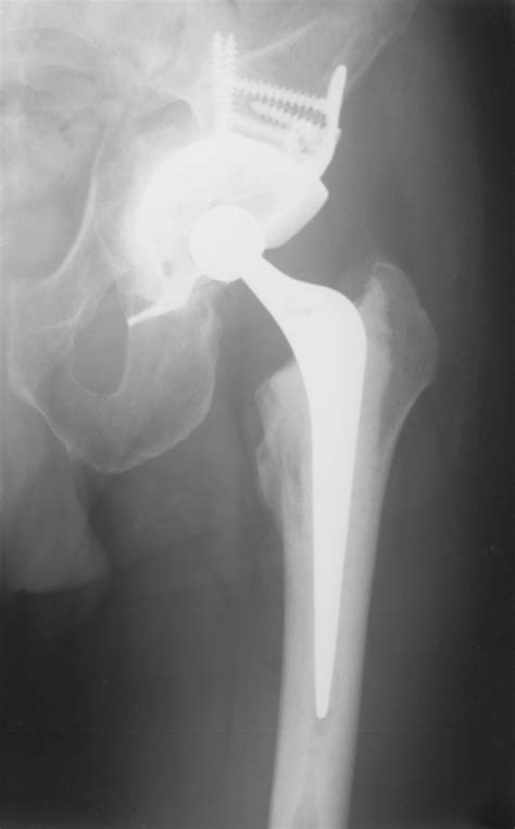 Preservation Of The Original Femoral Cement Mantle During The