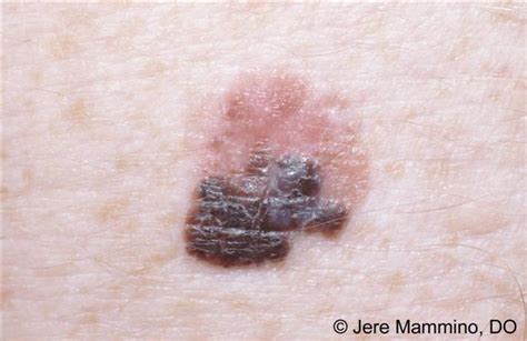 Early Malignant Melanoma In Situ