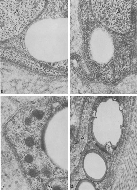 A D Sural Nerve High Resolution Electron Micrographs Of Schwann Cells