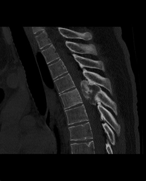 Vertebral Osteoblastoma Image Radiopaedia Org