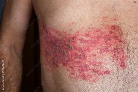 Stockfoto Skin Lesion Symptom In Shingles Or Herpes Zoster In Human