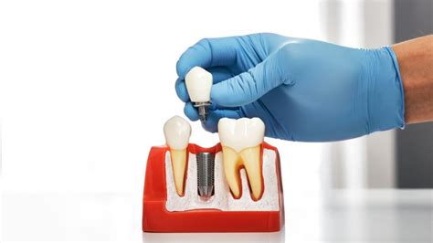 Tipos De Implante Dent Rio Conhe A Os Principais Modelos