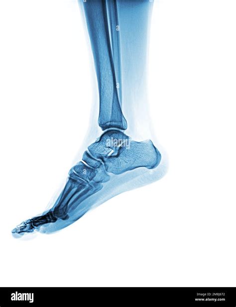 X Ray Normal Human Foot Lateral View Stock Photo Alamy