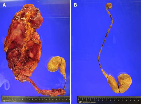 Ureteral Stent