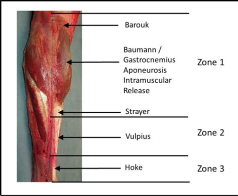 Figure 4 From The Evolution Of Gastrocnemius Soleus Lengthening In