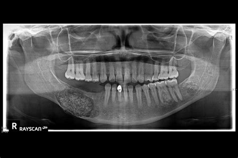 Clinical Case Diagnosis And Treatment Of A Large Central Ossifying