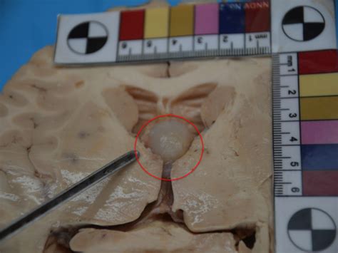 Brain section according horizontal plan: a 2cm pale grayish-white cyst... | Download Scientific ...