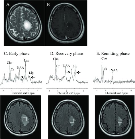 Brain MRI and MRS of the patient. (A, B) Brain MRI on hospital day 7 ...