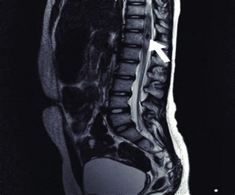 T Weighted Magnetic Resonance Image Taken On Hospital Day Shows