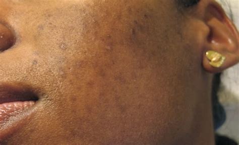 Hyperpigmentation Ou Irr Gularit Du Teint Comment En Venir Bout