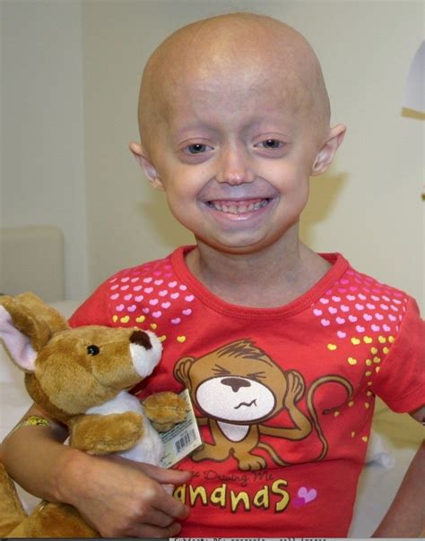 First Ever Drug Trial Reverses Some Signs Of Aging In Progeria Boston