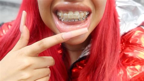 I GOT MY BRACES OFF Vanessa Lynn YouTube