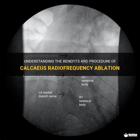 Understanding The Benefits And Procedure Of Calcaeus Radiofrequency