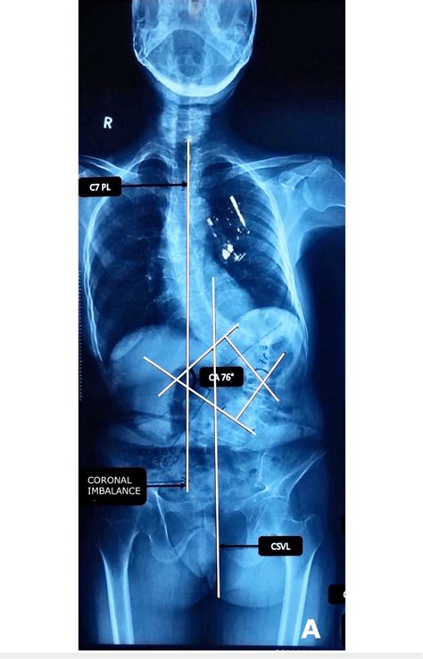 The 36 Inch Whole Spine Radiograph Anteroposterior View Shows A